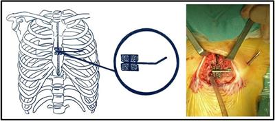 Case report: A simple and reliable approach for progressive internal distraction of the sternum for Jeune syndrome (asphyxiating thoracic dystrophy): preliminary experience and literature review of surgical techniques